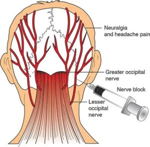 Occipital Nerve Blocker headache