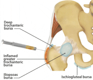 hip bursa injections