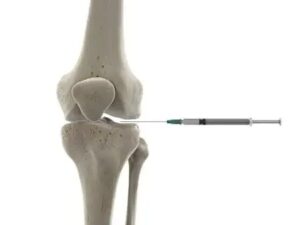 knee joint injection