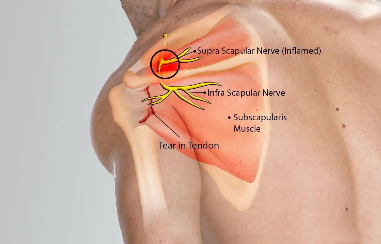 scapular nerve