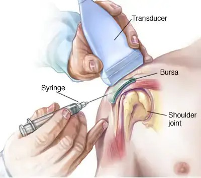 shoulder bursa injections sNKvor