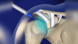 shoulder joint injections (1)