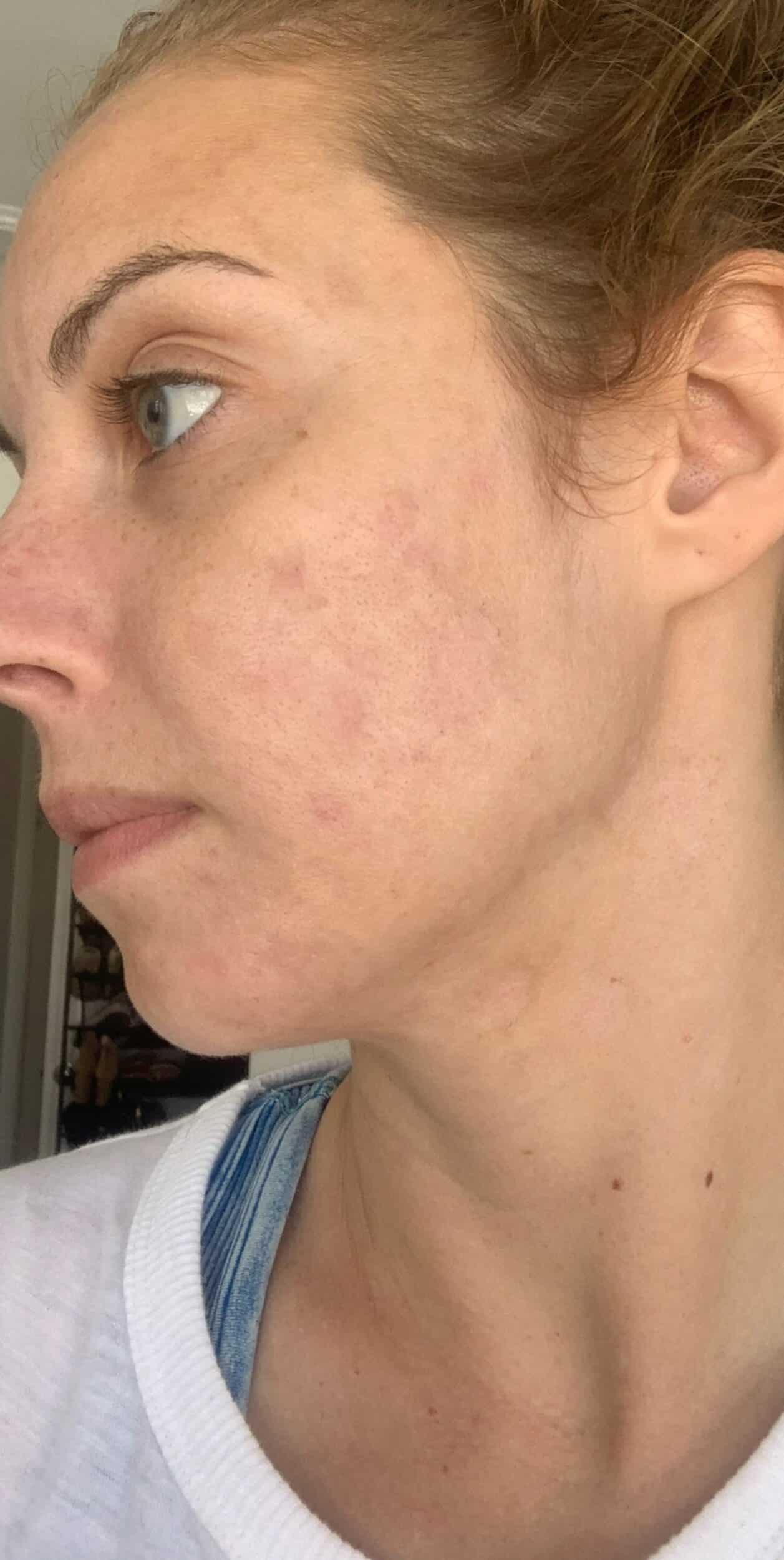 After Image: Forever Clear Acne - left-front-oblique