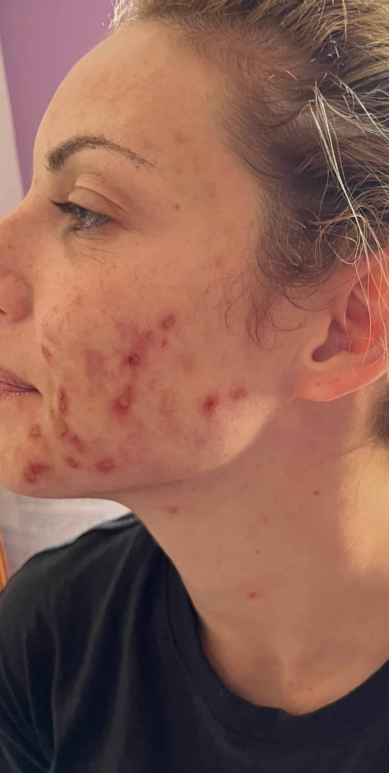 Before Image: Forever Clear Acne - left-front-oblique