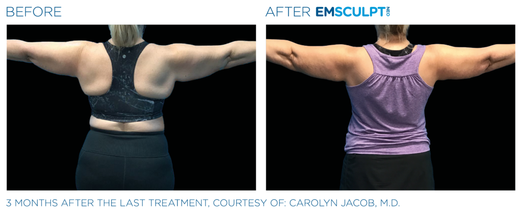 Emsculpt Neo PIC Ba card female arms 078 B ENUS100