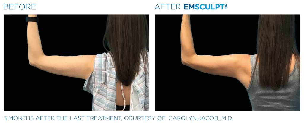 Emsculpt Neo PIC Ba card female arms 079 ENUS100
