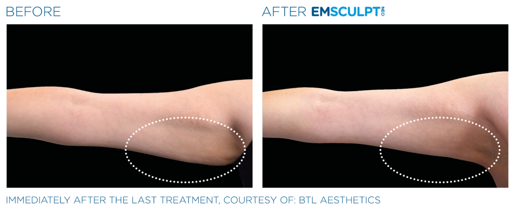 Emsculpt Neo PIC Ba card female arms 099 ENUS100