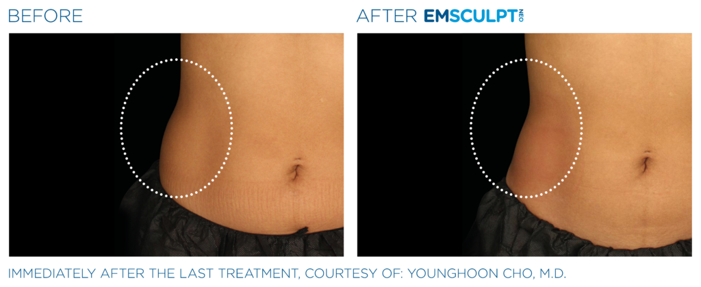 Emsculpt Neo PIC Ba card female lateral abdomen 151 ENUS100