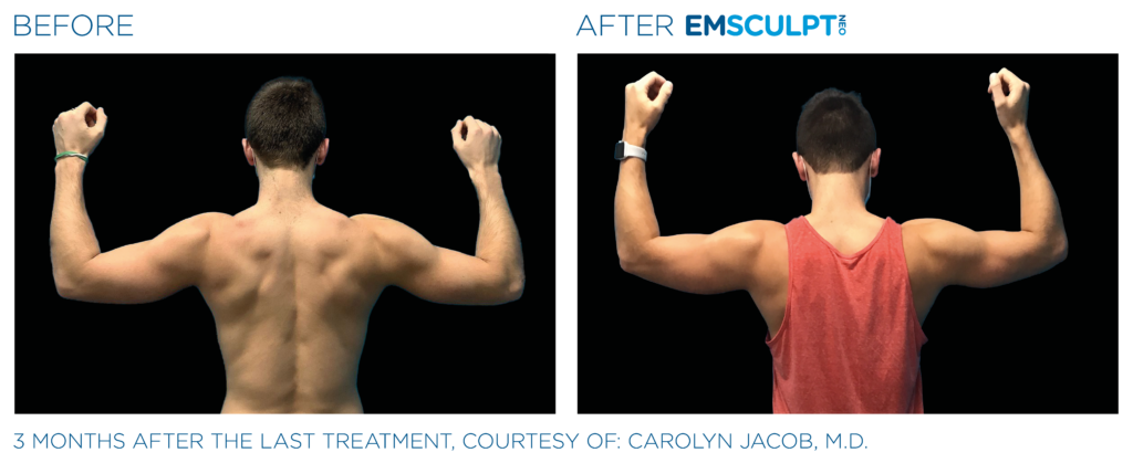 Emsculpt Neo PIC Ba card male arms 077 B ENUS100