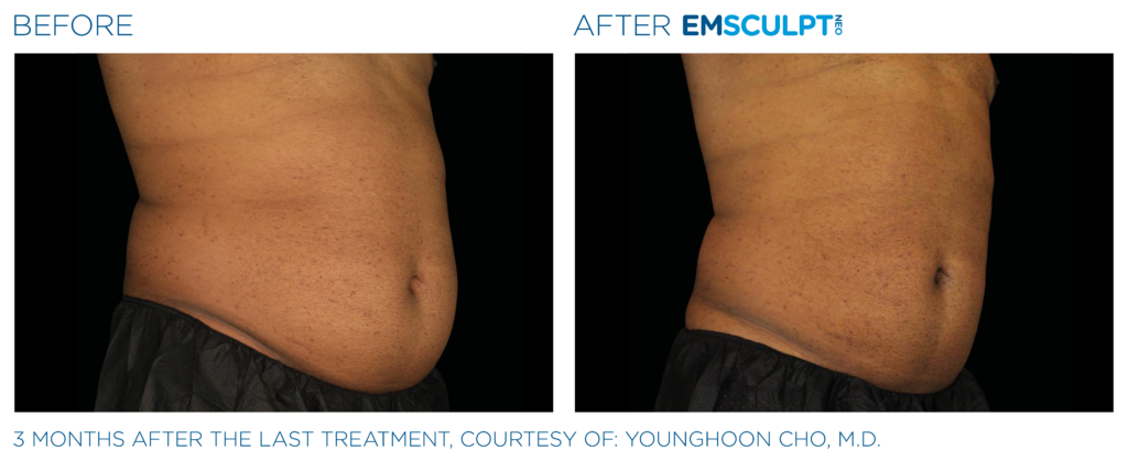 Emsculpt Neo PIC Ba card male lateral abdomen 149 ENUS100