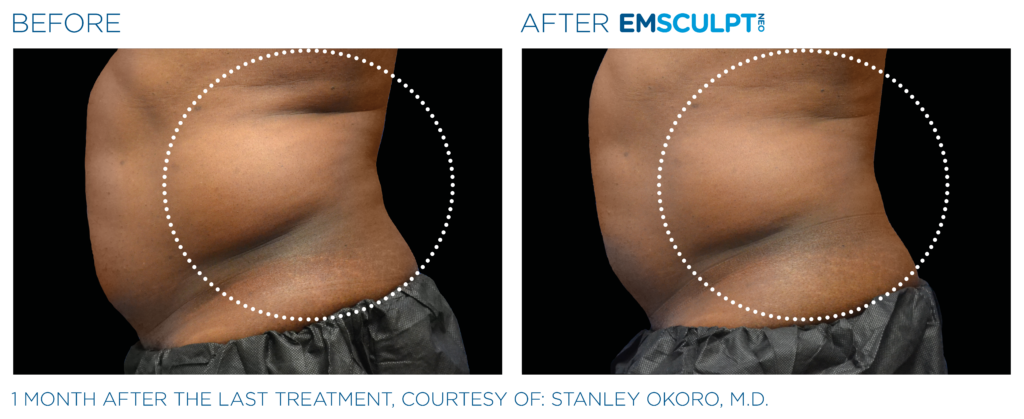 before and after Emsculpt Neo male Downriver MI