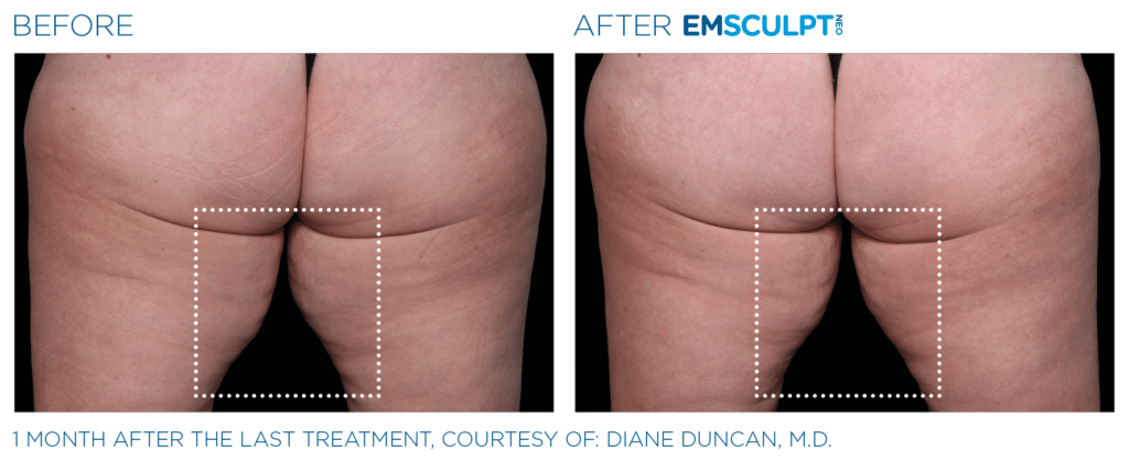Emsculpt neo PIC Ba card female inner thighs 069 ENUS100