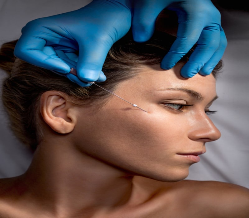 Woman's profile as her doctor injects PDO threads for a nonsurgical facelift