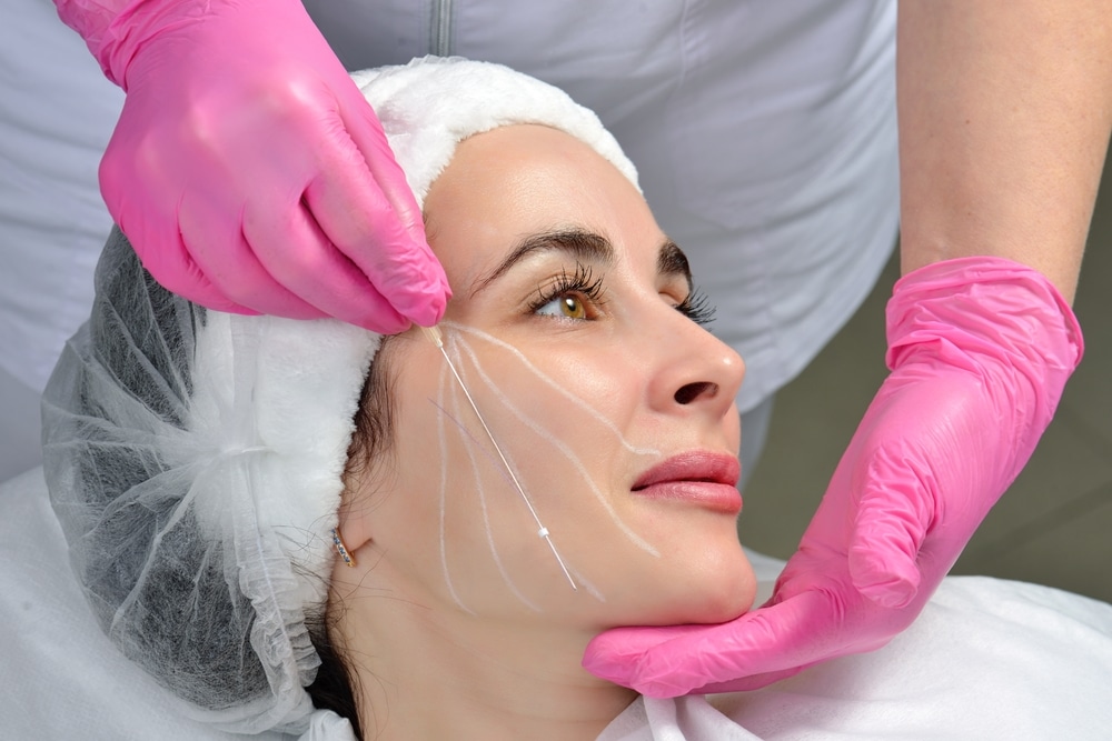 A woman smiles as her doctors injects PDO threads for a thread lift of sagging skin