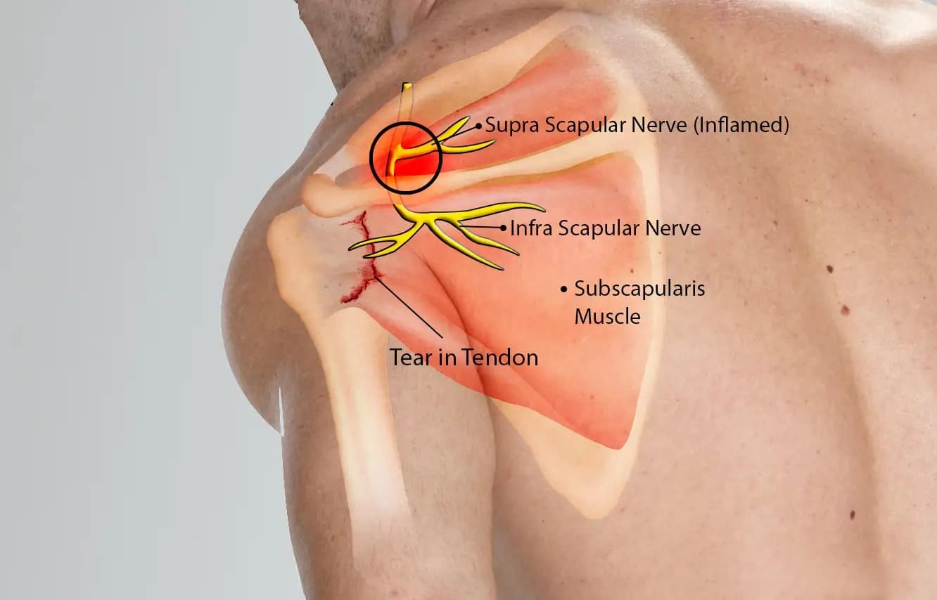 dystonion posterior Pain Injection Wyandotte MI