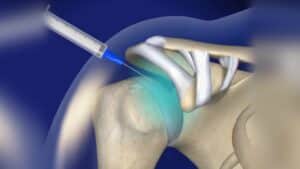dystonion posterior shoulder Pain treatment Downriver MI
