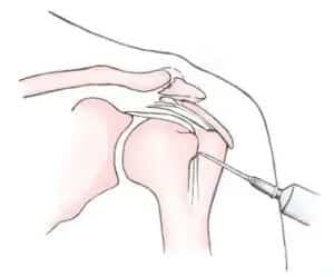 dystonion posterior biceps tendon KqNgl5Z