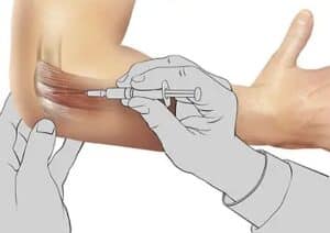 dystonion posterior elbow injections