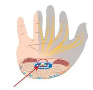 dystonion posterior carpal tunnel injection