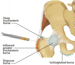 dystonion posterior hip bursa injections