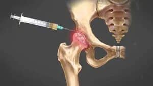dystonion posterior hip joint injection