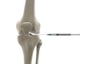 dystonion posterior knee joint injection