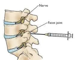 dystonion posterior back pain relief