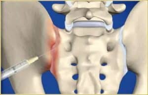 dystonion posterior sacroiliac injection