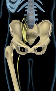 dystonion posterior Sciatic notch block