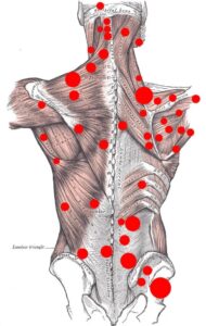 dystonion posterior Trigger Points